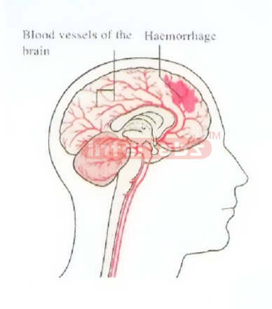 SUDDENLY HAEMORRHAGE MODEL IN HUMAN BRAIN